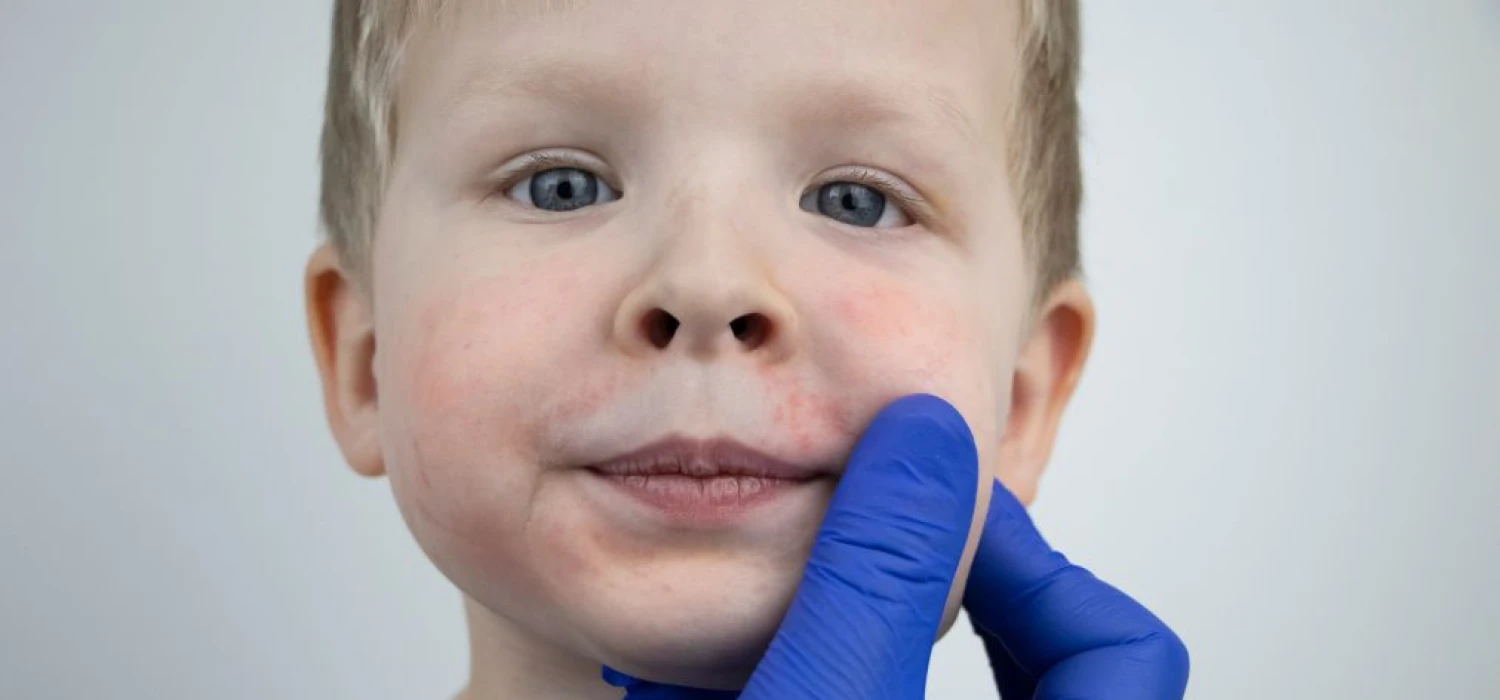 Alergia pokarmowa u dzieci – przyczyny i objawy