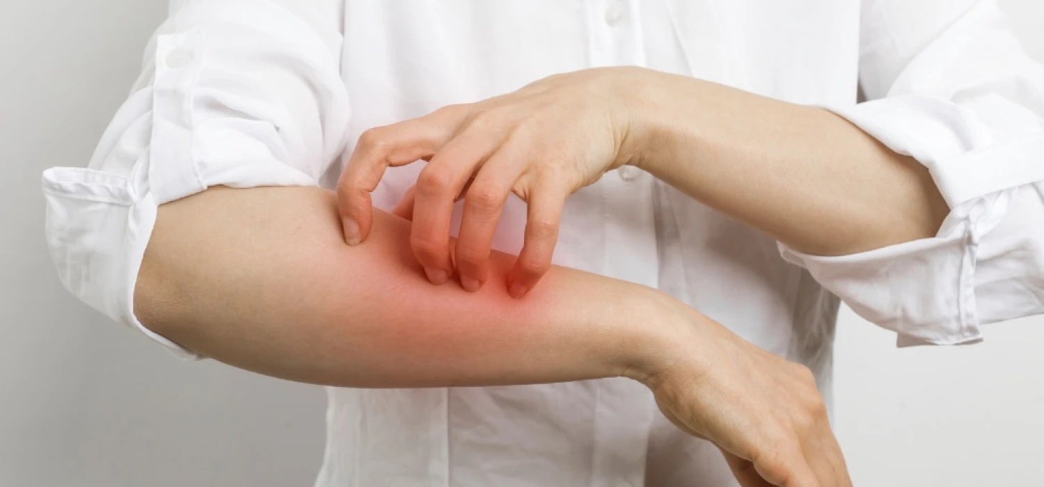 Alergia skórna – jak sobie z nią poradzić?