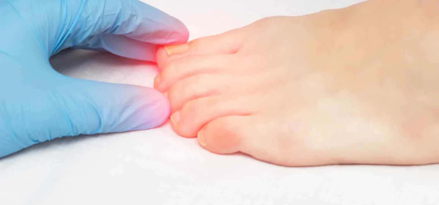 Choroby paznokci ‒ najczęściej występujące dolegliwości - zdjęcie