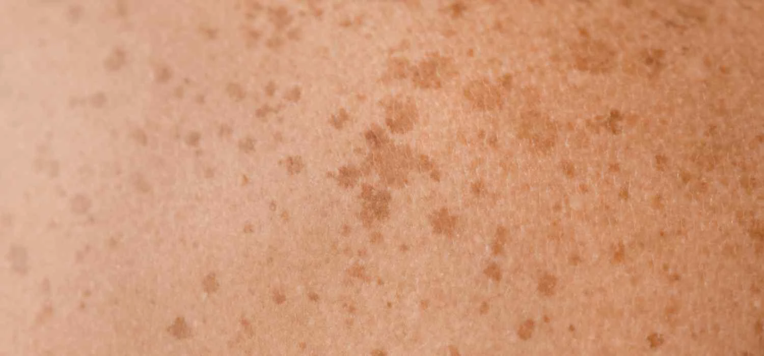 Nowotwór skóry ‒ wszystko, co musisz o nim wiedzieć