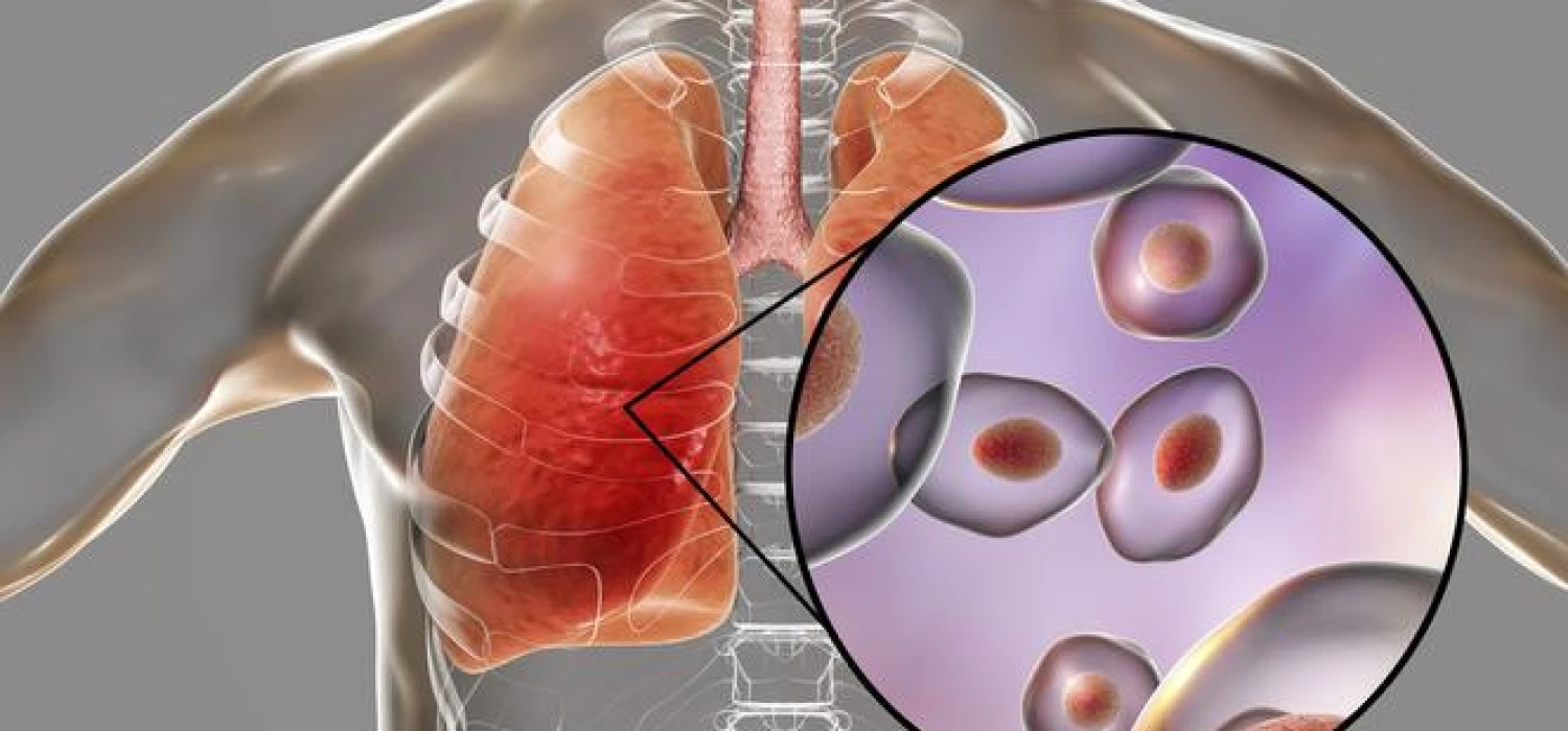 Pneumocystoza – co to, objawy, rozpoznanie i leczenie - zdjęcie