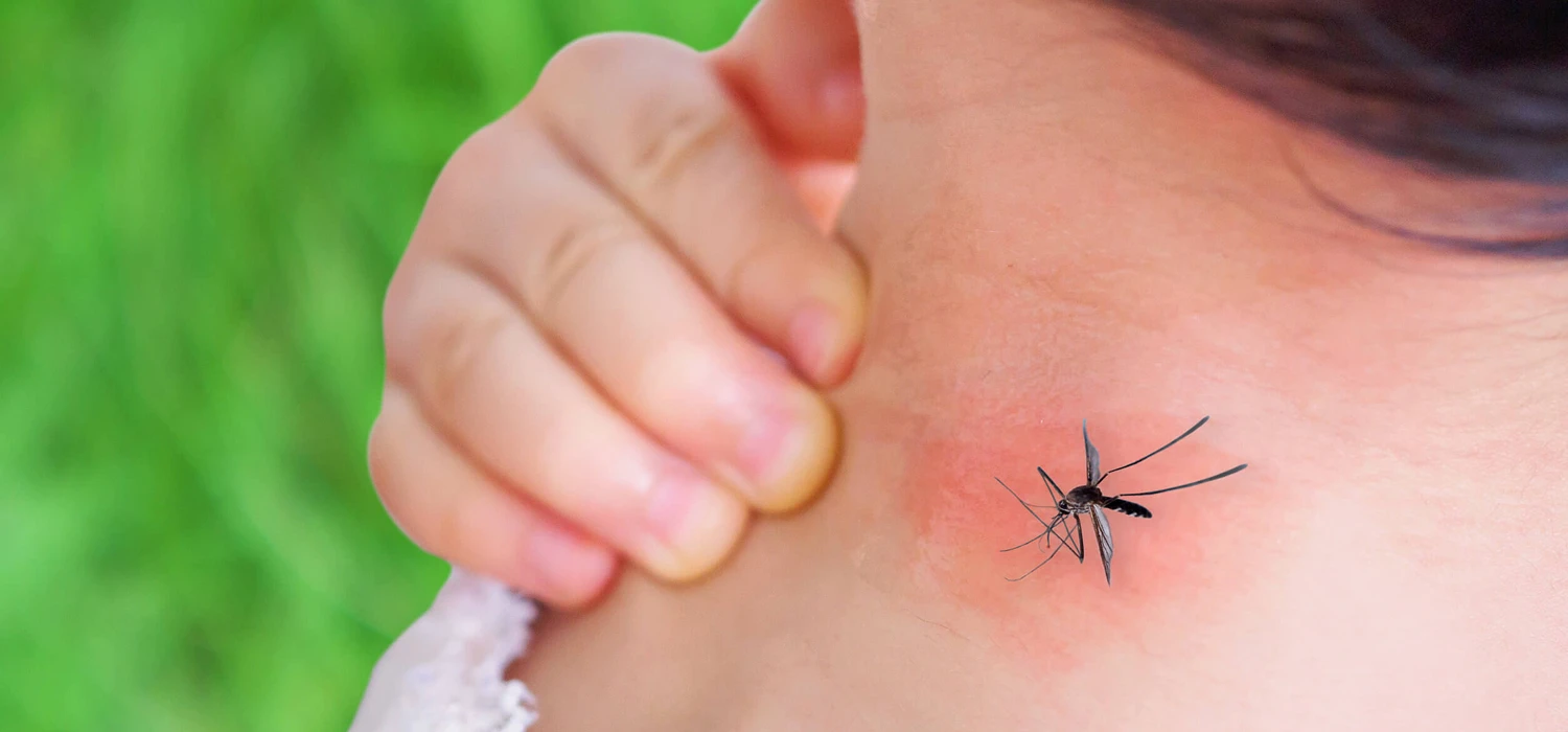 Uczulenie na komary. Jak się objawia, jakie są przyczyny oraz czy wymaga leczenia? - zdjęcie