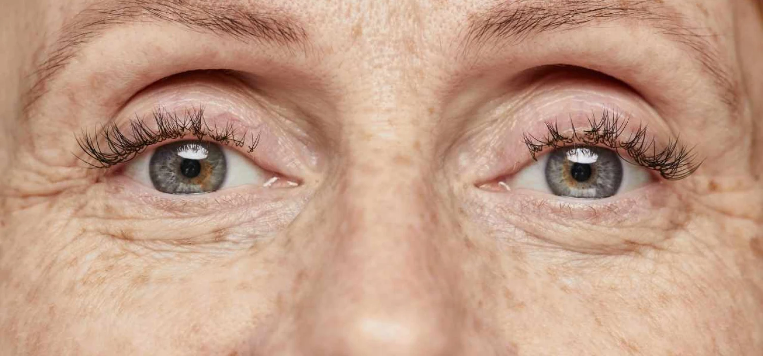 Wytrzeszcz oczu: przyczyny, objawy, leczenie
