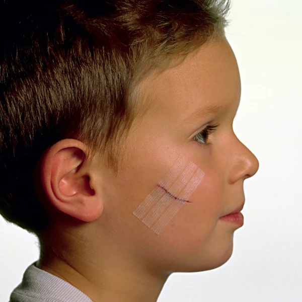viscoplast-steri-strip-paski-do-zamykania-ran-8-sztuk